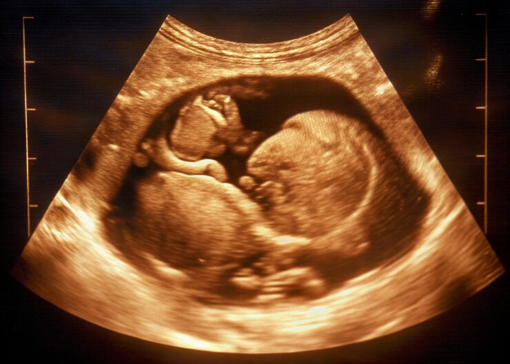 3D/4D Sonography